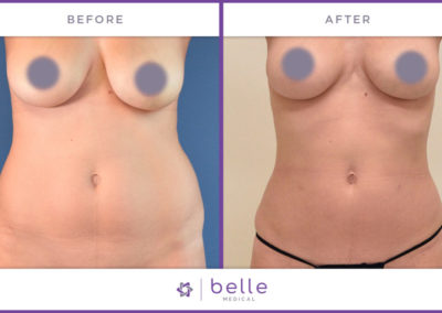 Belle_Medical-Before_After-Body_Sculpting-1-1024x640
