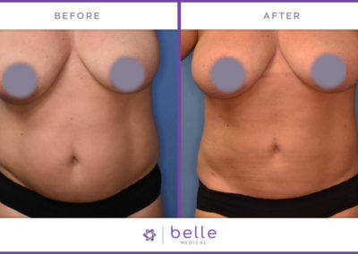 Belle_Medical-Before_After-Body_Sculpting-10-1024x640