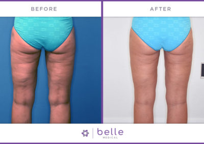 Belle_Medical-Before_After-Body_Sculpting-3-1024x640