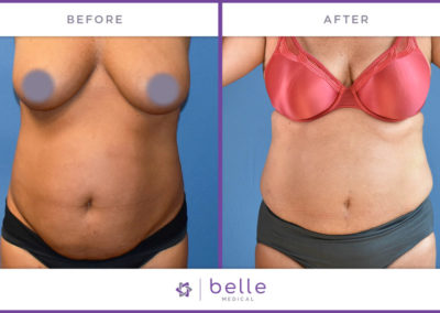 Belle_Medical-Before_After-Body_Sculpting-9-1024x640
