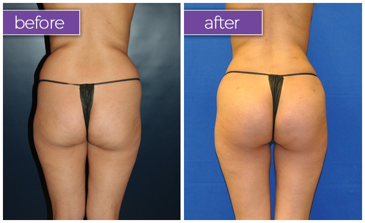 Fat-transfer-buttocks-4-BeforeandAfter