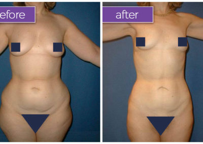 abdomen-hips-female-4-body-sculpting-belle-medical