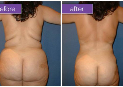 back-buttocks-female-5-body-sculpting-belle-medical
