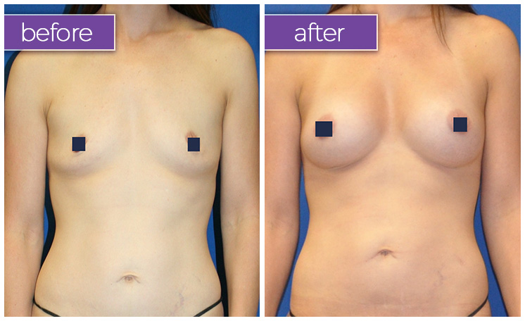 fat-transfer-breasts-2-BeforeandAfter-1