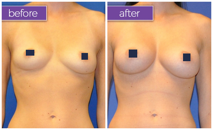 fat-transfer-breasts-3-BeforeandAfter-1