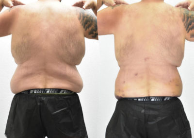 influencer-wayne-hd-body-sculpting-before-and-after