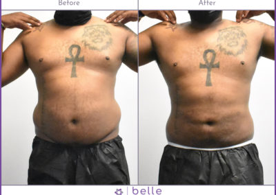 202108-male-stomach-before-after