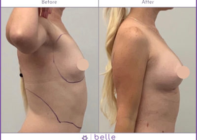 BM-Fat-Transfer-Before-After