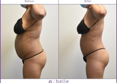 Woman-Stomach-v2-Before-After