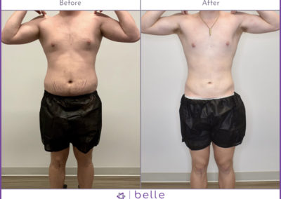 Young-Male-Stomach-BM-Before-After