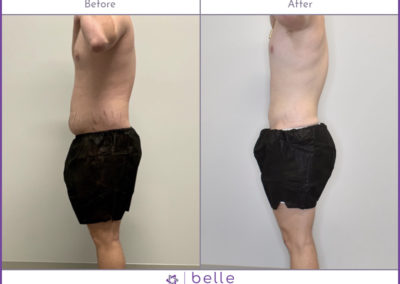 Young-Male-Stomach-BM-Before-After-v2