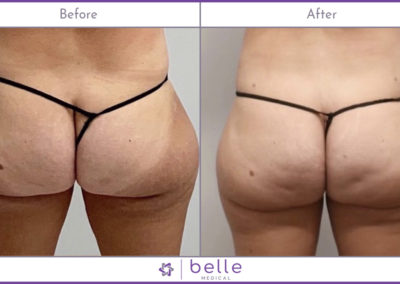 BM-Before-After-Hips